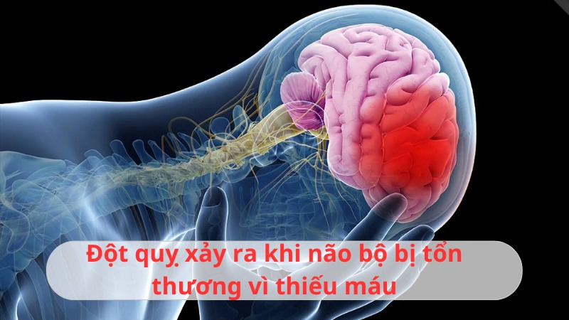 Đột quỵ là gì? Cách nhận biết đột quỵ và phòng tránh hiệu quả