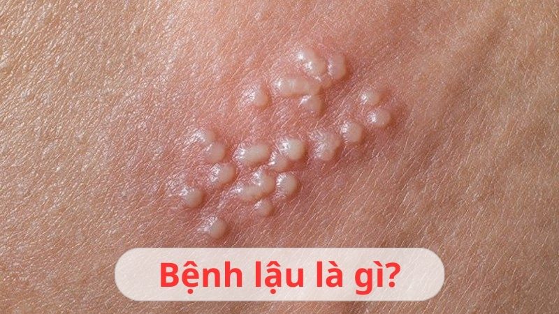 Bệnh lậu là gì? Cách điều trị và phòng tránh nhất định phải biết