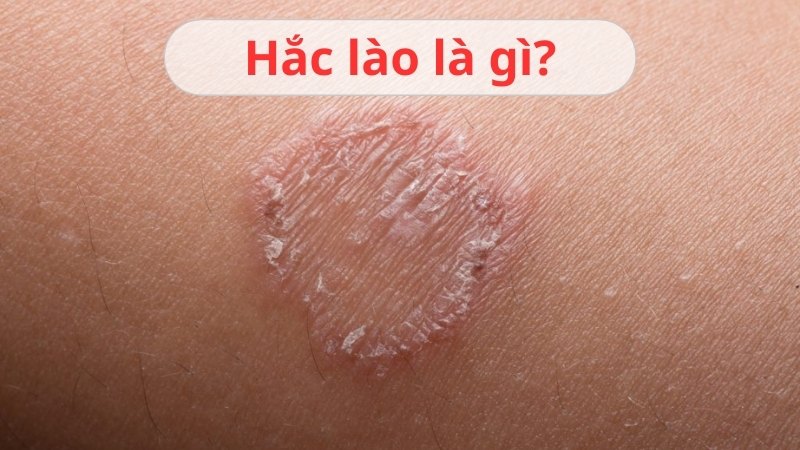 Hắc lào là gì? Giải đáp cách nhận biết bệnh và điều trị nhanh khỏi