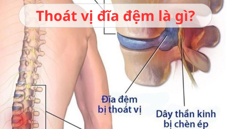 Thoát vị đĩa đệm là gì? Có thể chữa bệnh dứt điểm không?